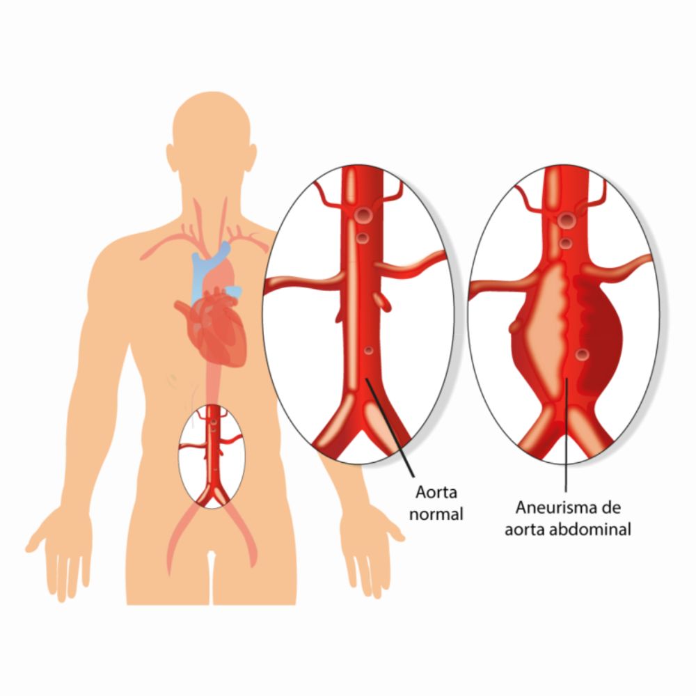 Painful varicose and spider veins on active womans legs, self-helping herself in overcoming the