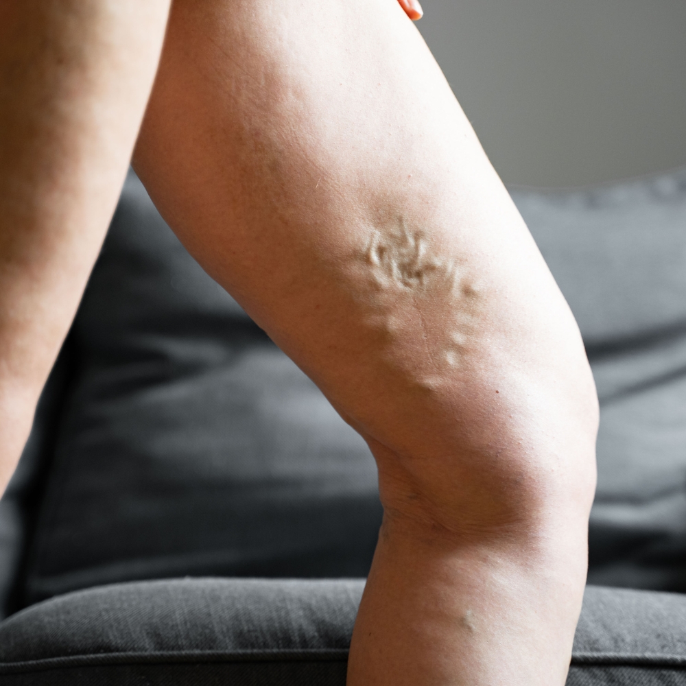 Painful varicose and spider veins on active womans legs, self-helping herself in overcoming the