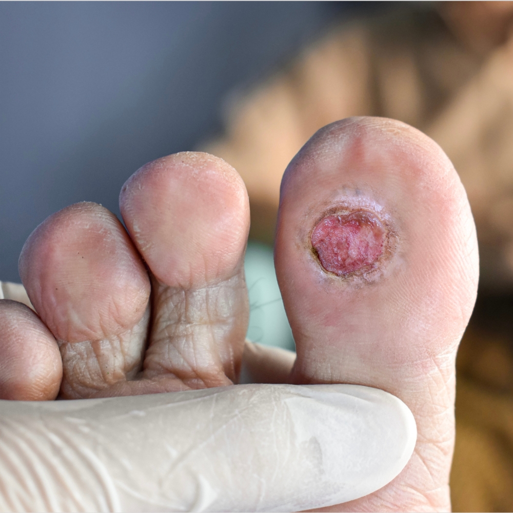 Painful varicose and spider veins on active womans legs, self-helping herself in overcoming the