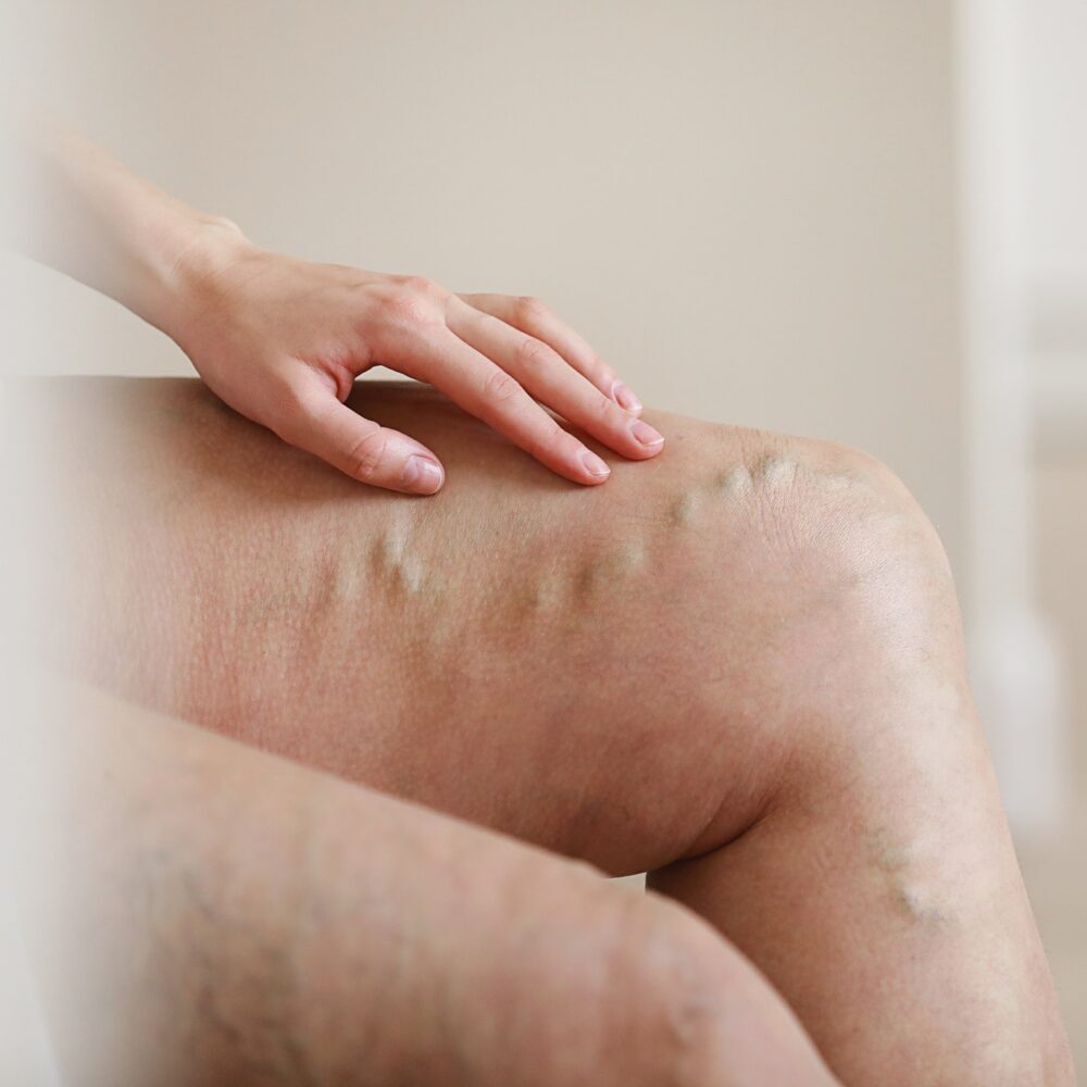 Painful varicose and spider veins on active womans legs, self-helping herself in overcoming the